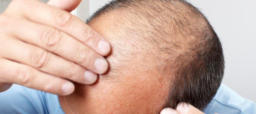 زراعة الشعر في تركيا