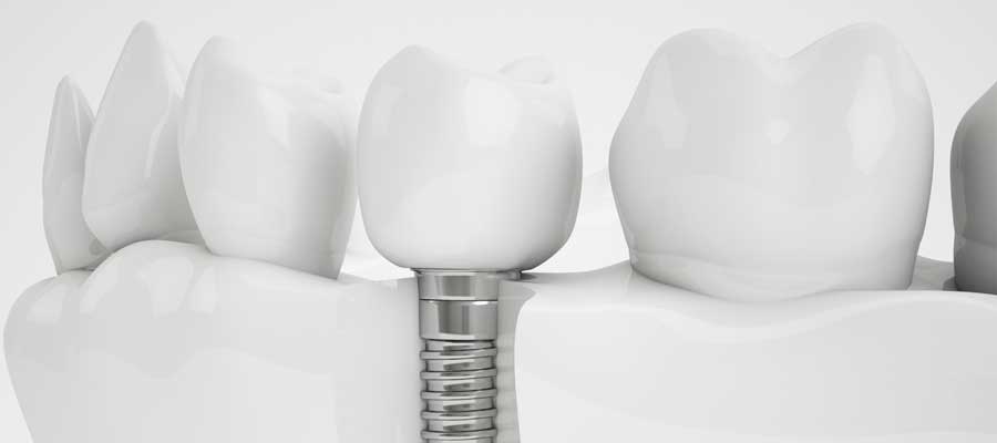 Dental Implant In Turkey