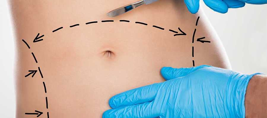 Abdominoplastie